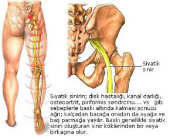 Siyatik (Siyatalji - Siyatik Sinir nevraljisi)